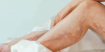 Woman's legs with varicose veins wrapped in a luxurious satin