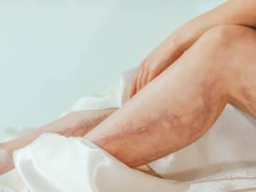 Woman's legs with varicose veins wrapped in a luxurious satin