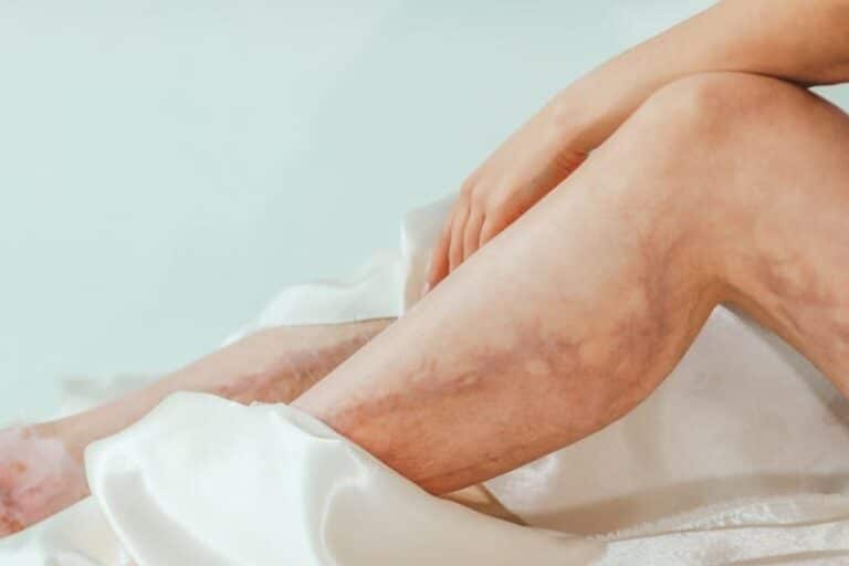 Woman's legs with varicose veins wrapped in a luxurious satin